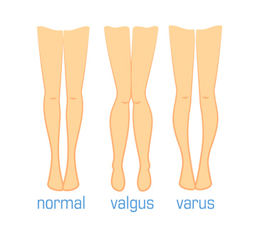 Illustration zum Vergleich von drei Beinstellungen: normal (gerade), Valgus (Knie nach innen gewinkelt) und Varus (Knie nach außen gewinkelt).