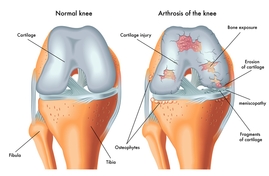 Gegenüberstellung eines normalen Knies und eines Knies mit Arthrose, mit Darstellung von gesundem Knorpel und Knorpelschäden, freiliegenden Knochen, Osteophyten und anderen Schäden.