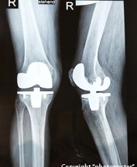 Röntgenbilder eines rechten Knies mit einem Kniegelenkersatz aus Metall in Vorder- und Seitenansicht.