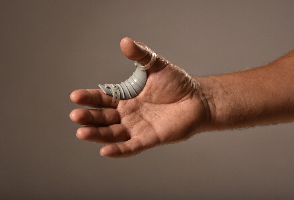 Eine menschliche Hand mit einer Daumenprothese wird vor einem neutralen Hintergrund gezeigt.