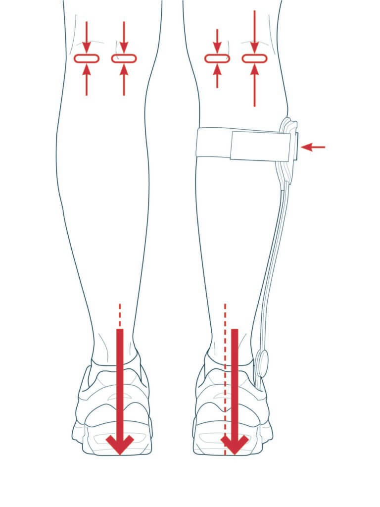 Das Diagramm zeigt die Rückenansicht von zwei Unterschenkeln, einer davon mit einer Bandage. Die roten Pfeile zeigen die Kräfte und die Bewegungsrichtung am Knie und an der Ferse an.