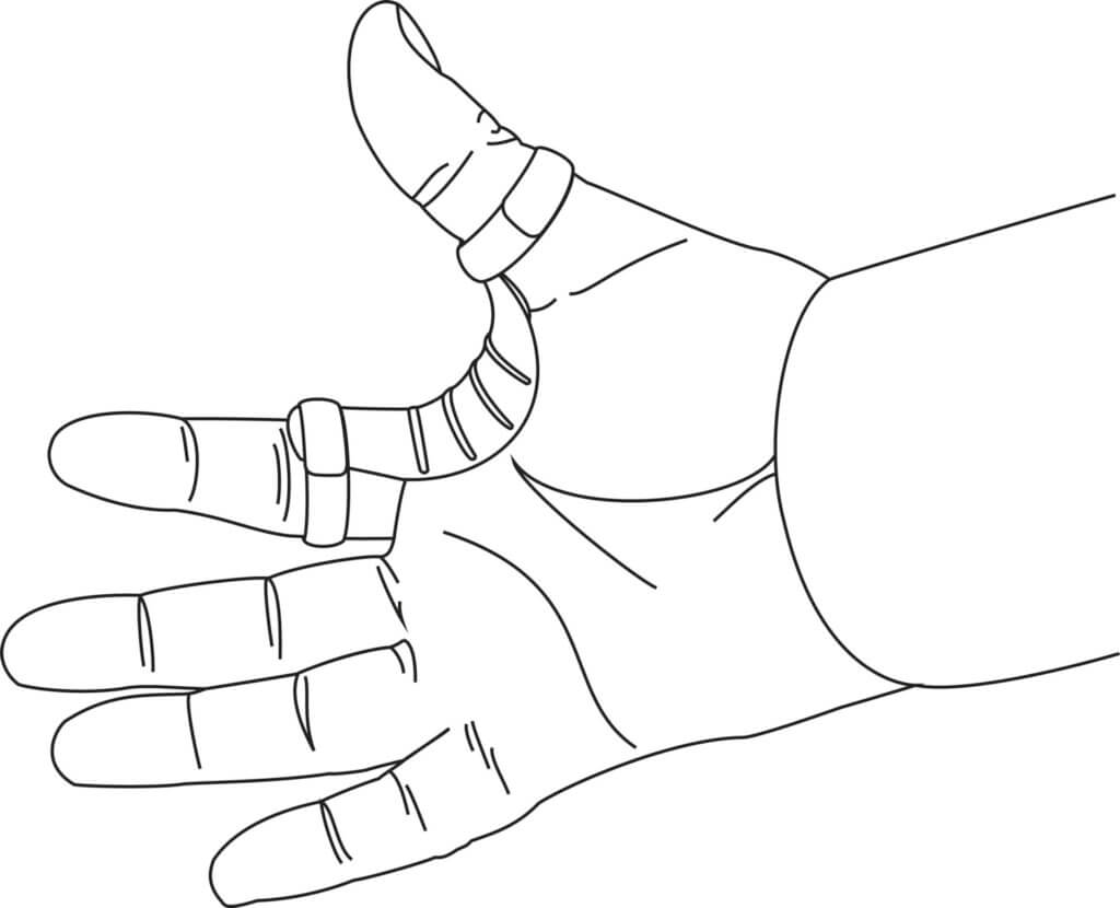 Eine Hand, bei der Daumen und Mittelfinger mit medizinischem Klebeband umwickelt sind, wobei die Handfläche nach oben zeigt und die Finger gespreizt sind.