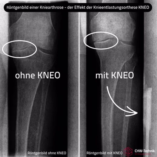 Nebeneinander liegende Röntgenbilder des Knies zeigen weniger Gelenkraum (links, ohne KNEO) und mehr Gelenkraum mit einer Knieorthese (rechts, mit KNEO).